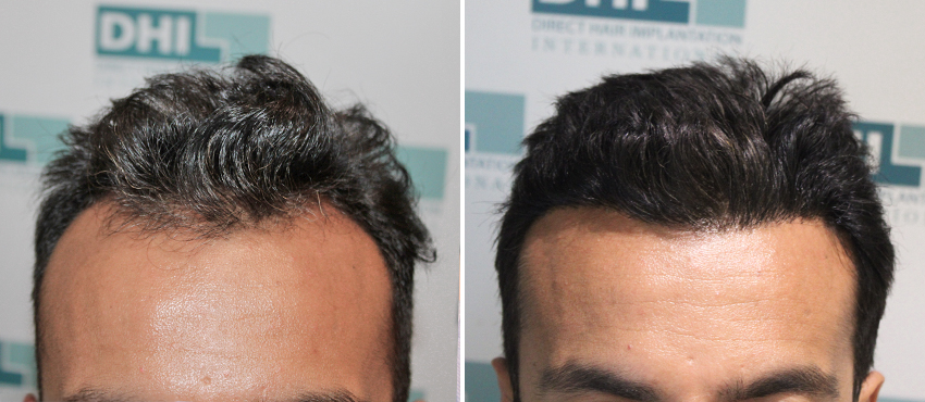 DHI before & after hair transplant results